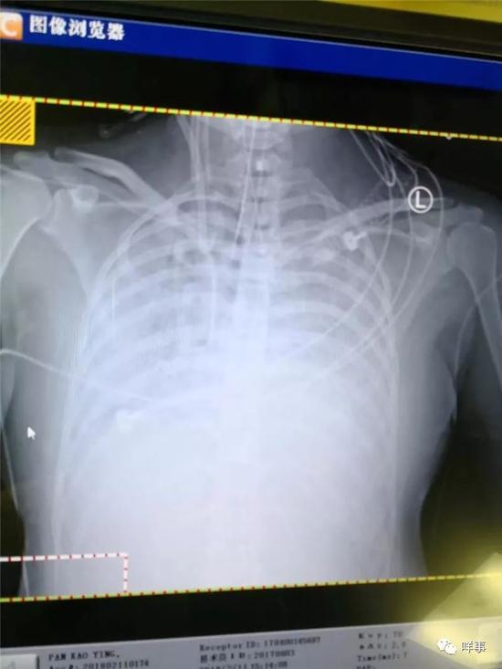 住进ICU的第二天，李云的双肺呈现可怕的大白肺。近乎没有肺功能。