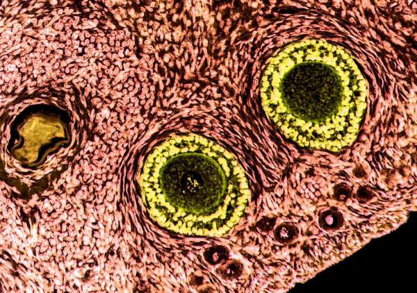 Ovarian follicles, containing immature eggs, sit within the ovarian tissue which can now be decellularised to remove the risk of cancers tissue being reintroduced